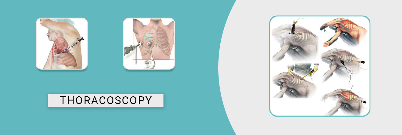 Thoracoscopy