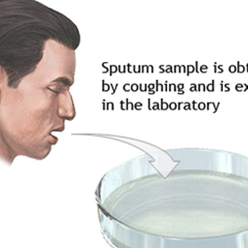 Sputum Production
